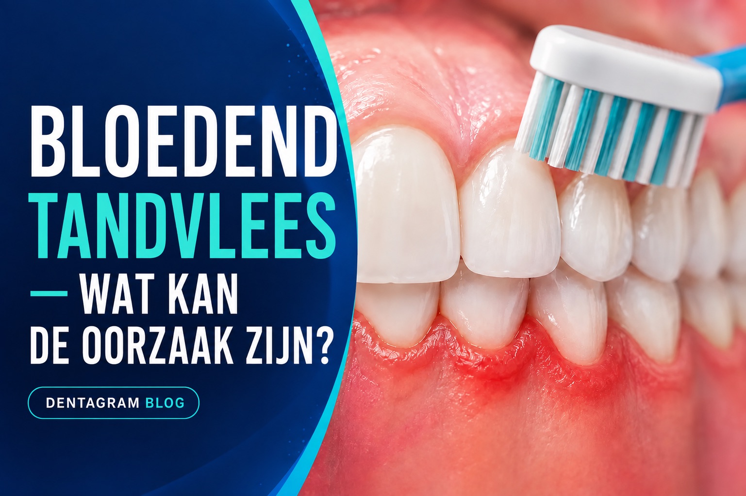 Bloedend tandvlees: mogelijke oorzaken Bloedend tandvlees en mogelijke oorzaken