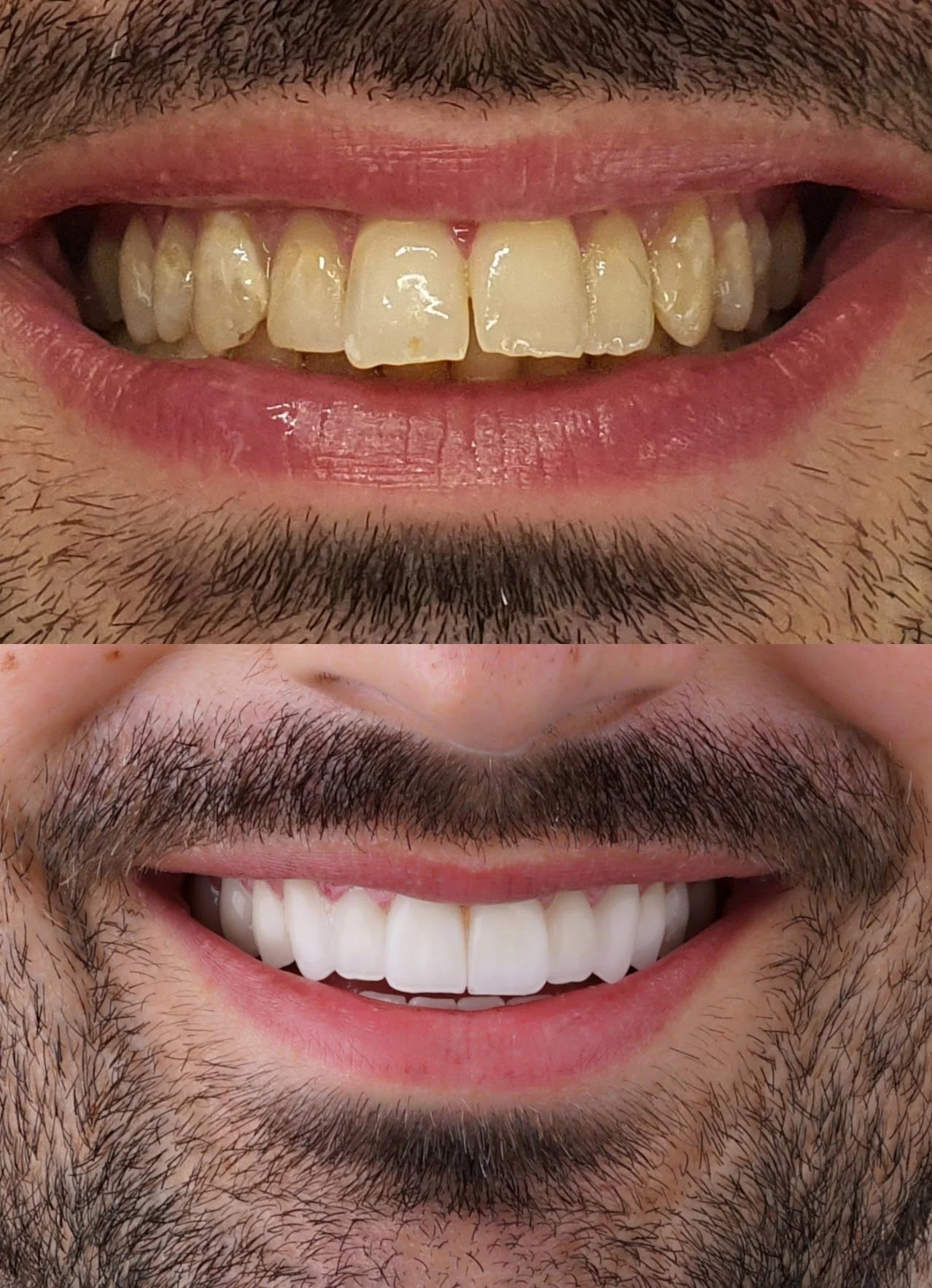 Dentagram Smile Gallery – Case 04 Voor en na een tandheelkundige behandeling bij Dentagram Istanbul, casus 04