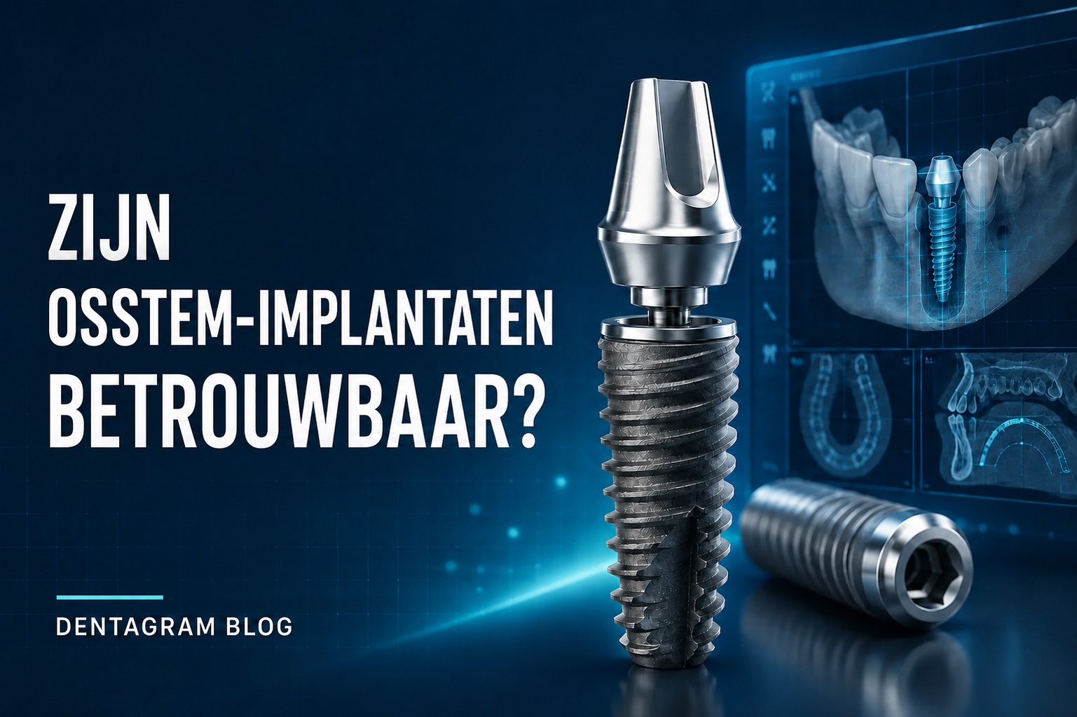 Zijn Osstem-implantaten betrouwbaar? Osstem-implantaten en digitale behandelplanning
