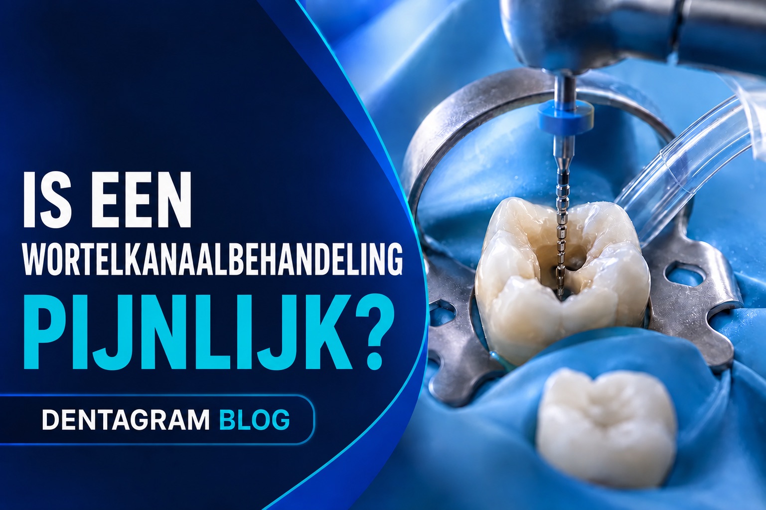 Is een wortelkanaalbehandeling pijnlijk? Wortelkanaalbehandeling onder rubberdam