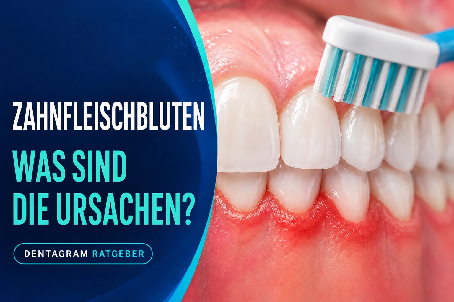 Zahnfleischbluten – mögliche Ursachen