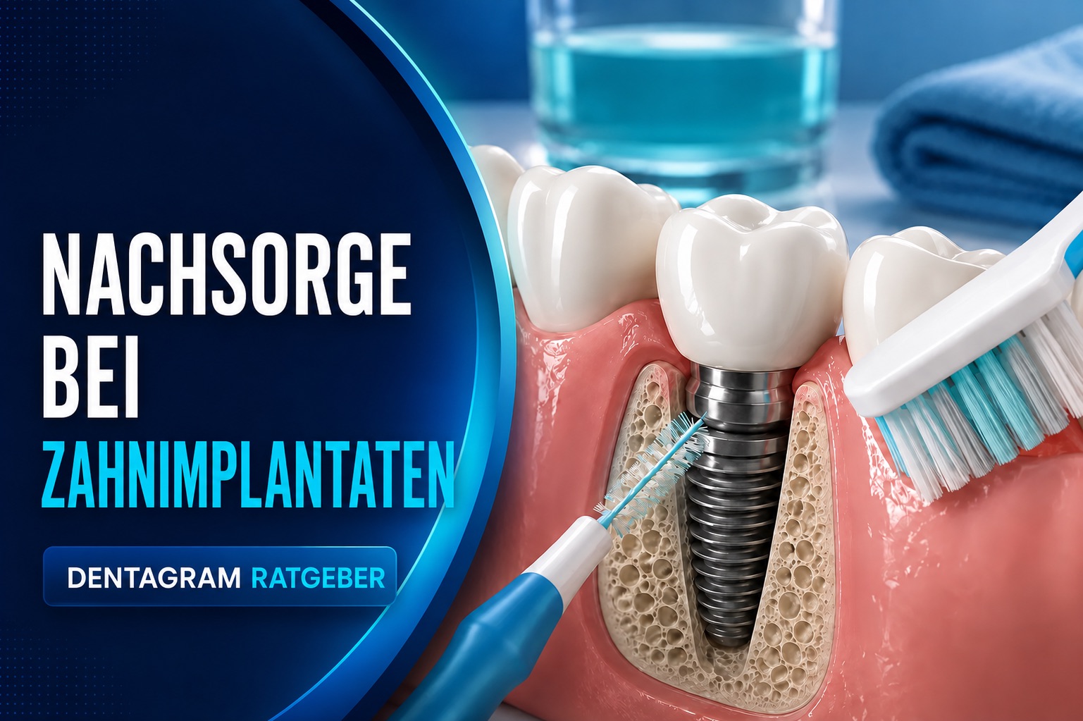 Nachsorge bei Zahnimplantaten mit Zahnb&uuml;rste und Interdentalb&uuml;rste